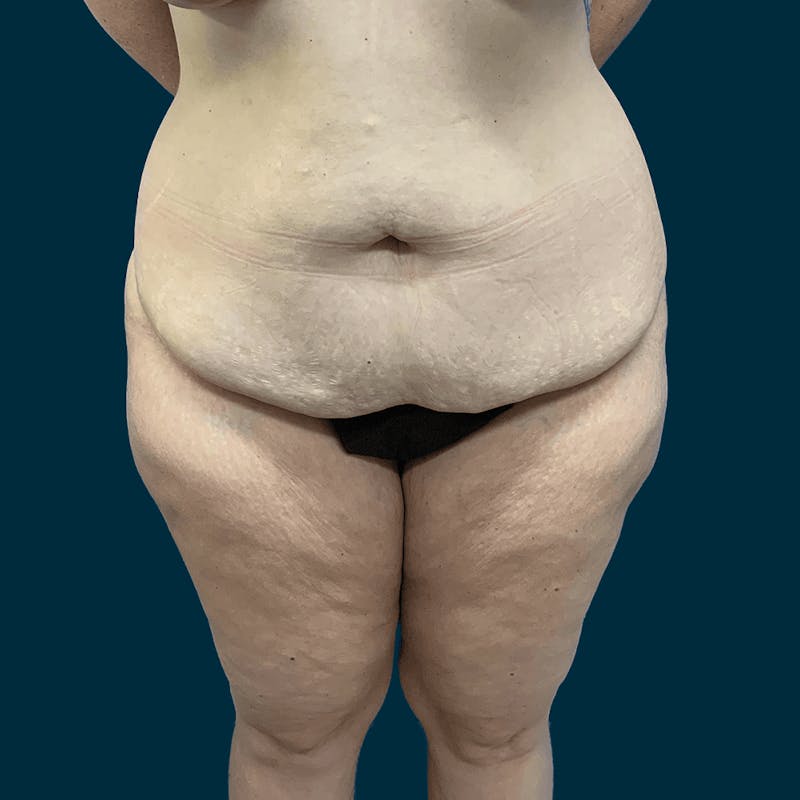 Body Lift Before & After Gallery - Patient 415350 - Image 1