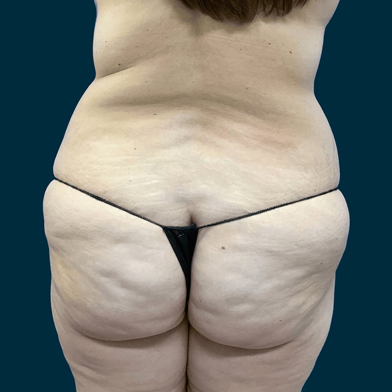 Body Lift Before & After Gallery - Patient 415350 - Image 5