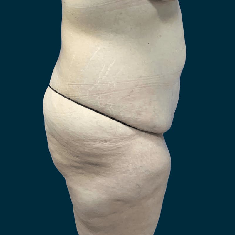 Body Lift Before & After Gallery - Patient 415350 - Image 3