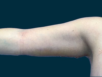 Brachioplasty Before & After Gallery - Patient 290745 - Image 2