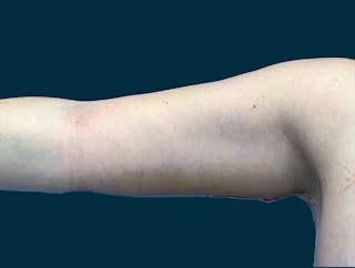 Brachioplasty Before & After Gallery - Patient 290745 - Image 2