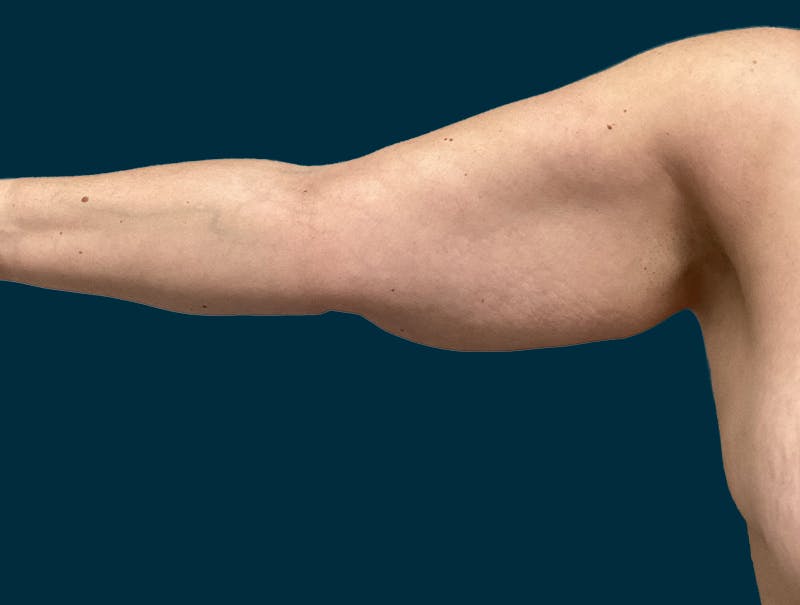 Patient LTozzcr0Rk2UEqAAJMUx2A - Arm Lift Before & After Photos