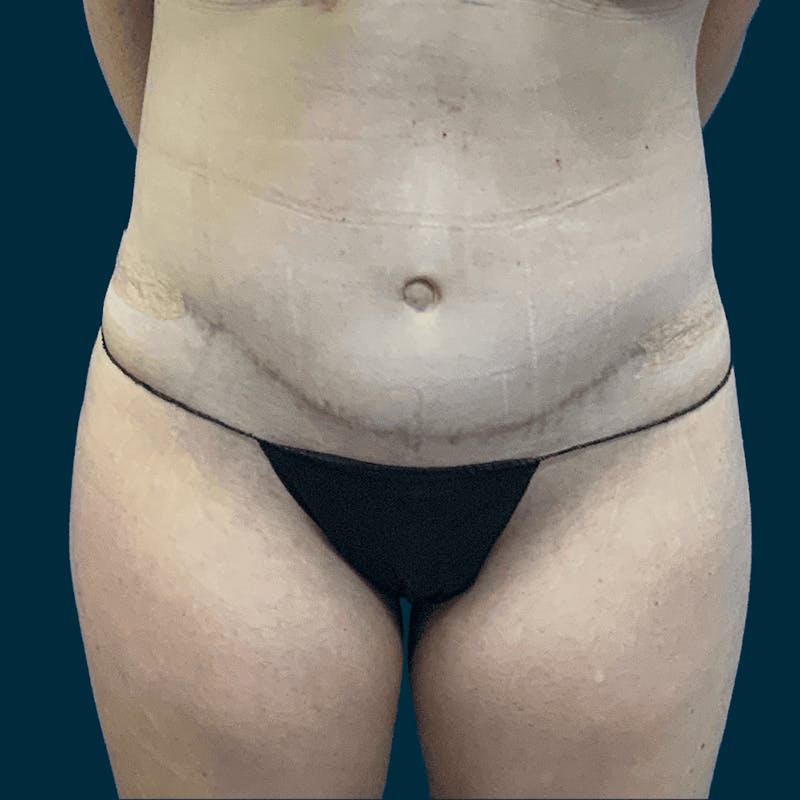 Body Lift Before & After Gallery - Patient 255939 - Image 2