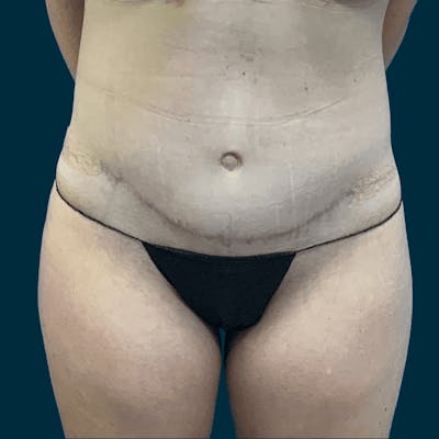 Body Lift Before & After Gallery - Patient 378771 - Image 2