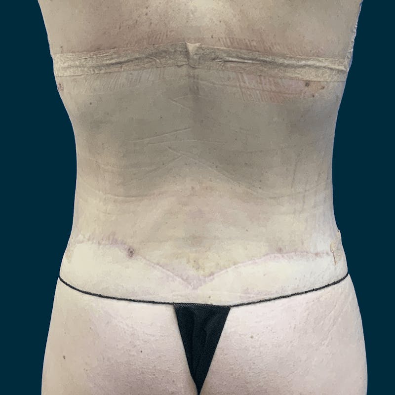 Body Lift Before & After Gallery - Patient 378771 - Image 4