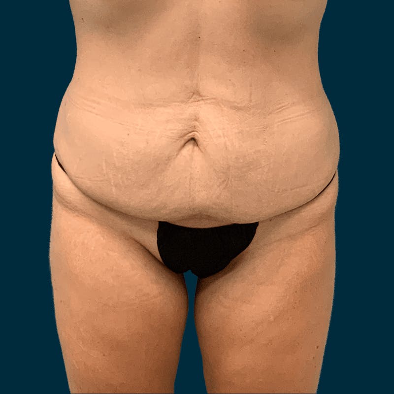 Patient QgV69GnuSc-EA9X8h6L-sQ - Body Lift Before & After Photos