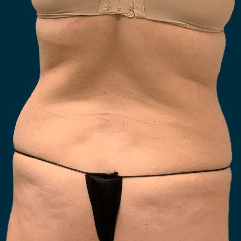 Body Lift Before & After Gallery - Patient 378771 - Image 3