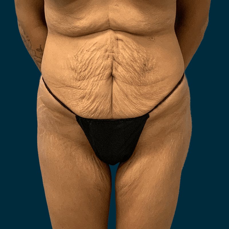Body Lift Before & After Gallery - Patient 369360 - Image 1