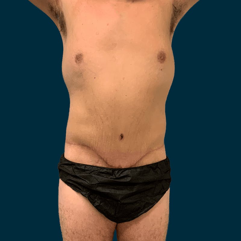 Body Lift Before & After Gallery - Patient 377364 - Image 2