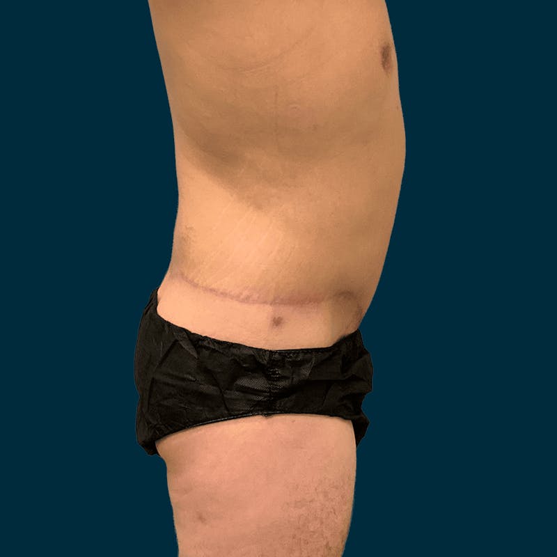 Body Lift Before & After Gallery - Patient 377364 - Image 4