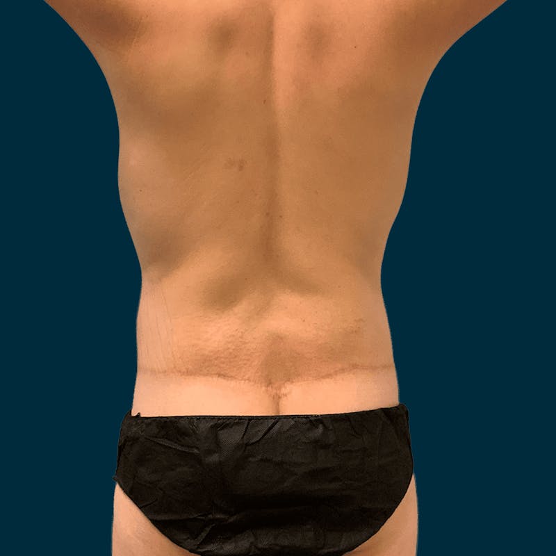 Body Lift Before & After Gallery - Patient 377364 - Image 6