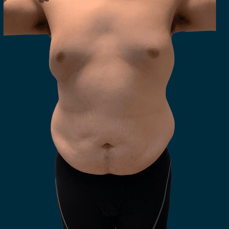 Body Lift Before & After Gallery - Patient 377364 - Image 1