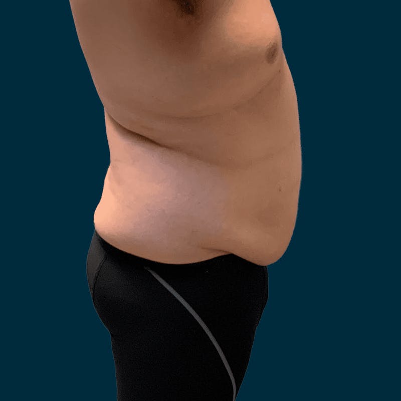 Body Lift Before & After Gallery - Patient 377364 - Image 3