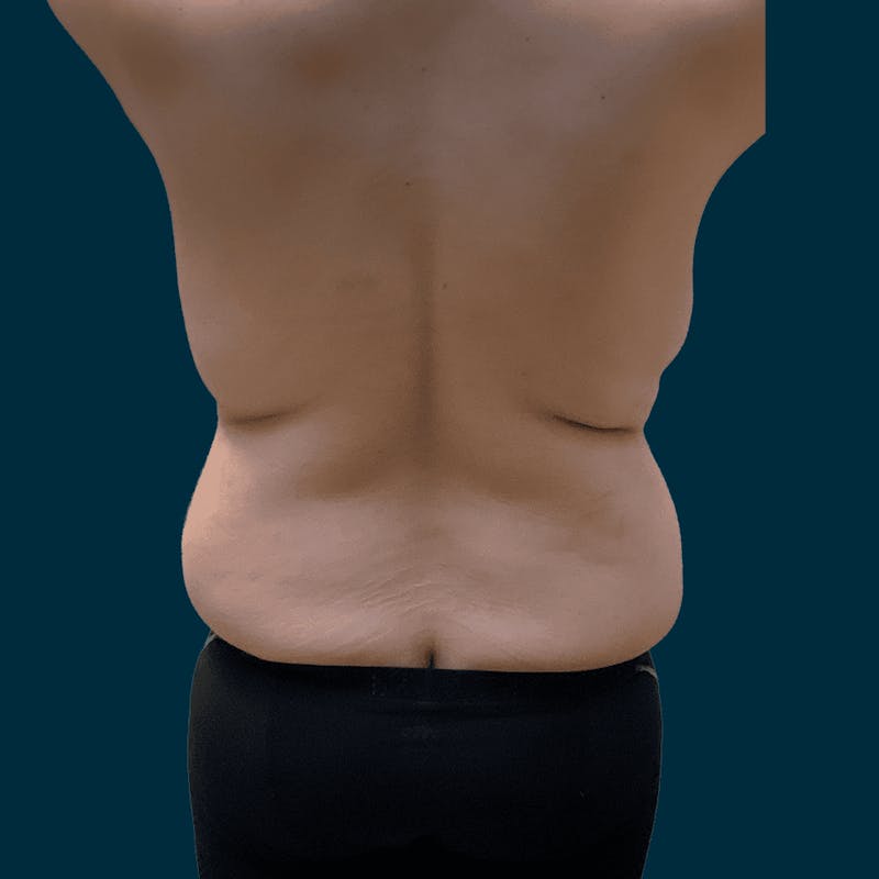 Body Lift Before & After Gallery - Patient 377364 - Image 5