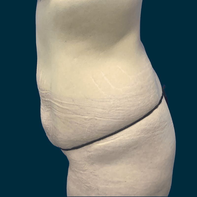 Abdominoplasty Before & After Gallery - Patient 113540 - Image 3