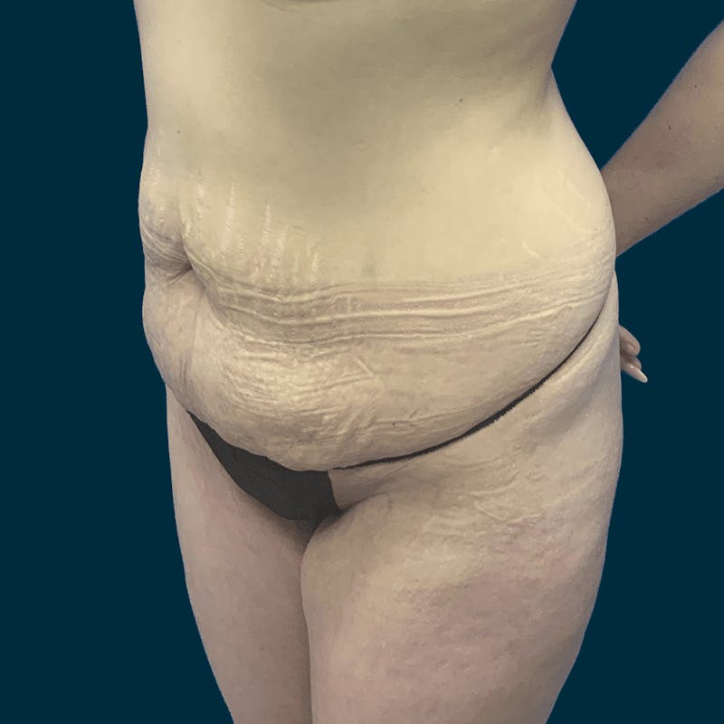Abdominoplasty Before & After Gallery - Patient 113540 - Image 5