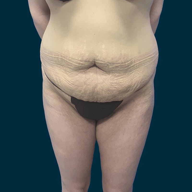 Abdominoplasty Before & After Gallery - Patient 113540 - Image 1
