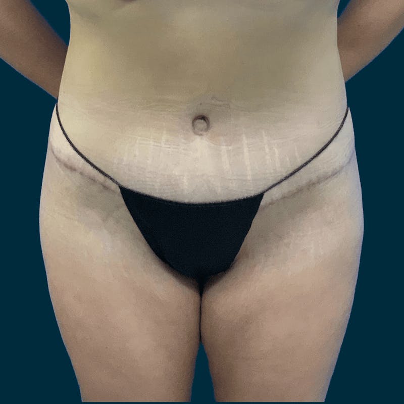Abdominoplasty Before & After Gallery - Patient 113540 - Image 2