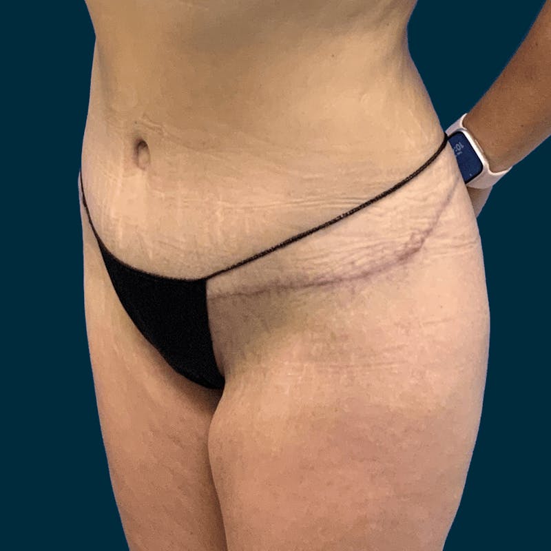 Abdominoplasty Before & After Gallery - Patient 113540 - Image 6