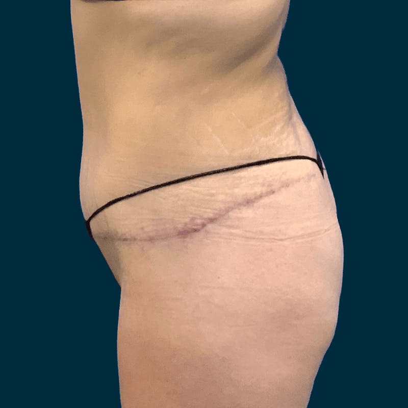 Abdominoplasty Before & After Gallery - Patient 113540 - Image 4