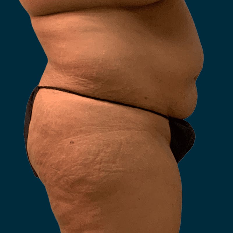 Liposuction Before & After Gallery - Patient 134163 - Image 3