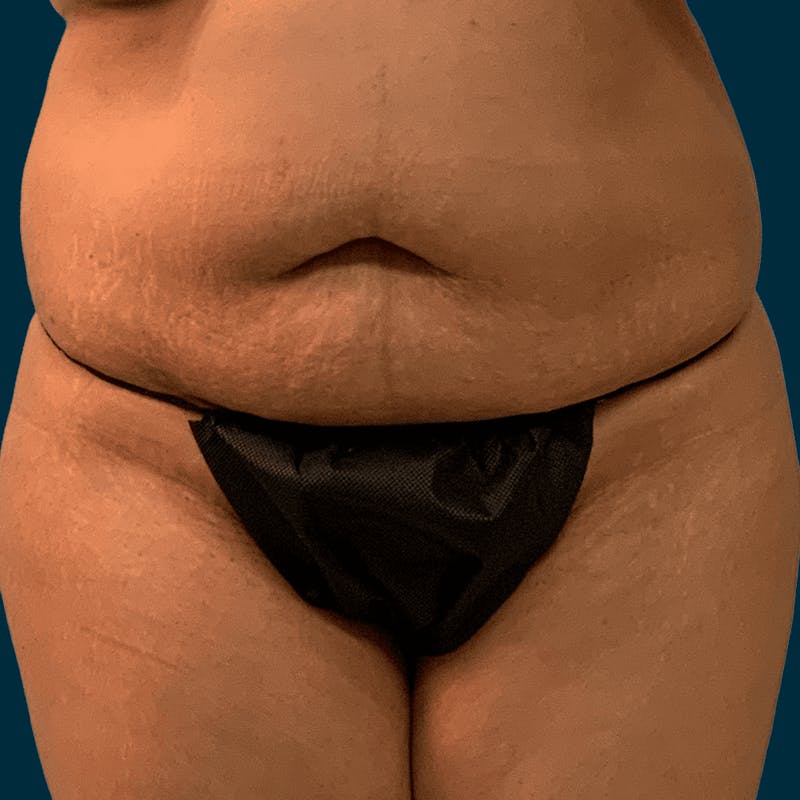 Liposuction Before & After Gallery - Patient 134163 - Image 1