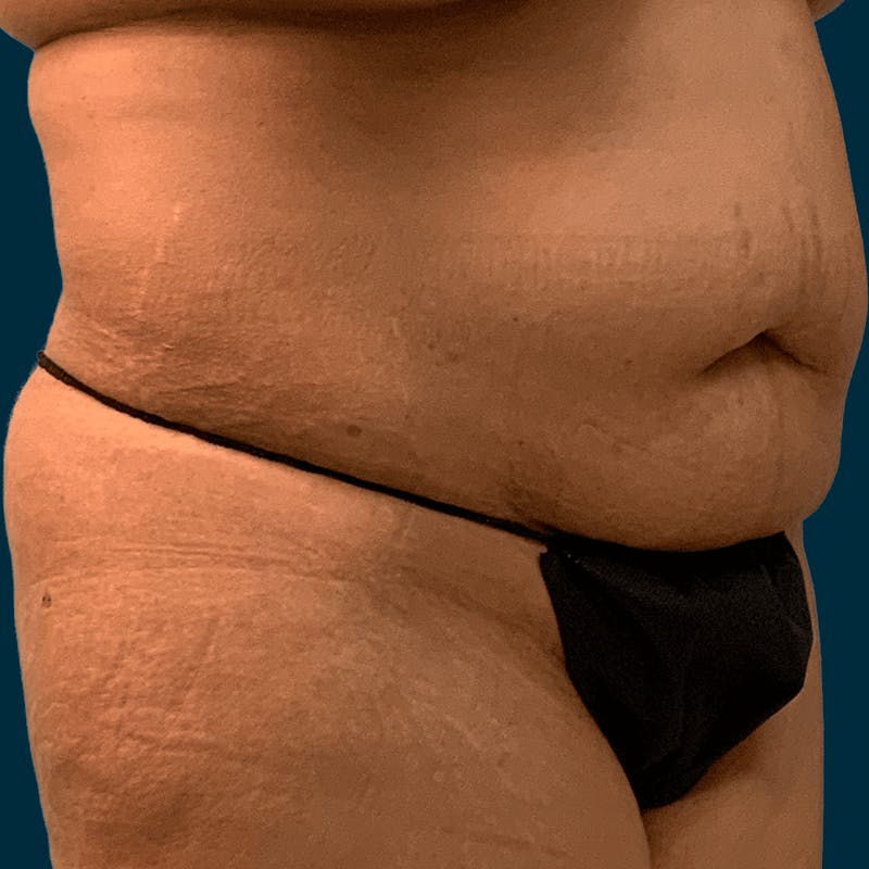 Liposuction Before & After Gallery - Patient 134163 - Image 5