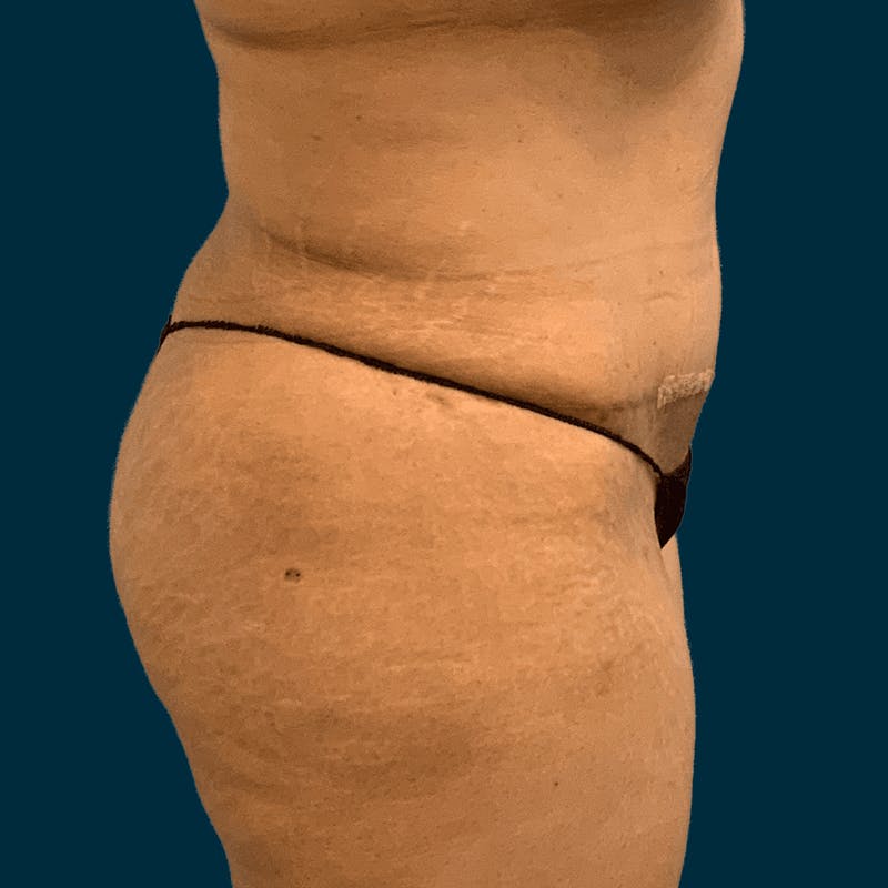 Liposuction Before & After Gallery - Patient 134163 - Image 4