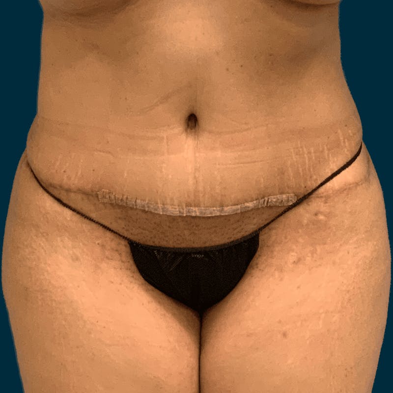 Abdominoplasty Before & After Gallery - Patient 268698 - Image 2