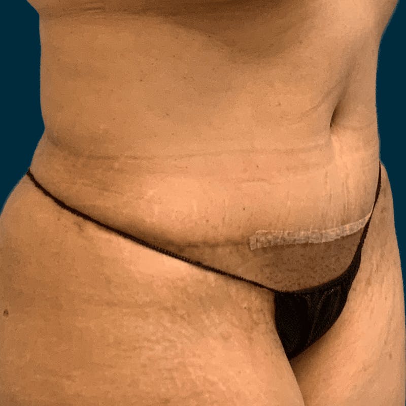 Abdominoplasty Before & After Gallery - Patient 268698 - Image 4