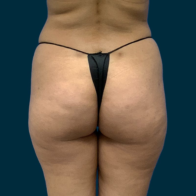 Patient UMTgR9TBT3mBjLWWZdOiwg - Fat Transfer Before & After Photos