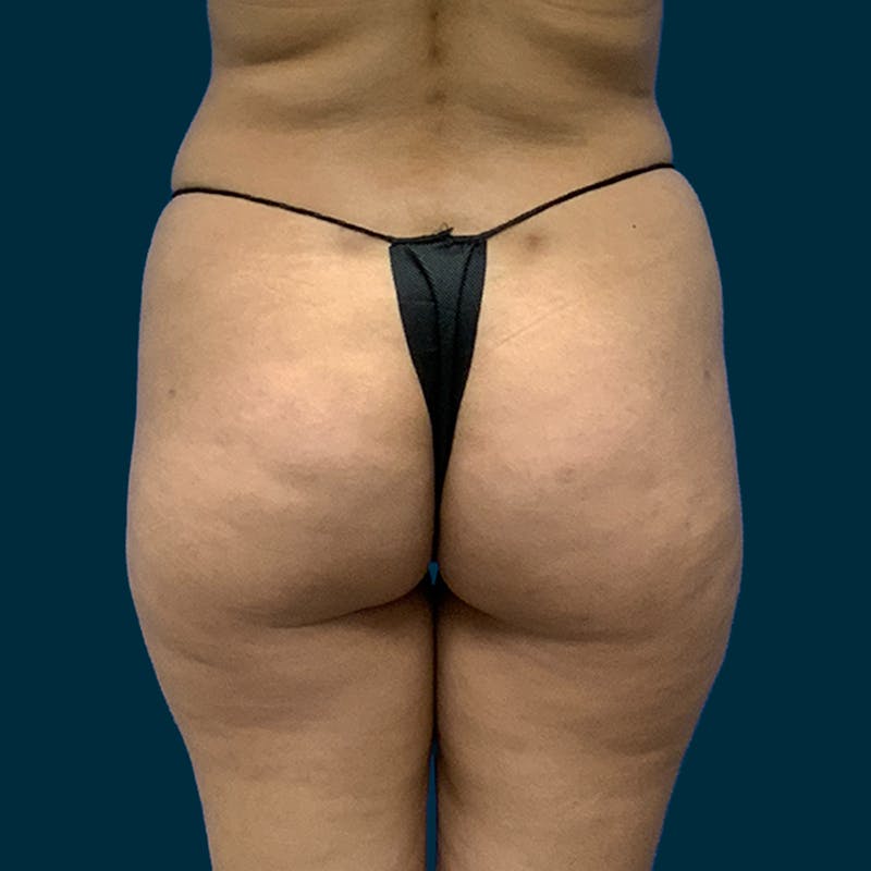 Fat Transfer Before & After Gallery - Patient 370161 - Image 1