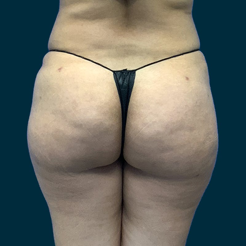 Liposuction Before & After Gallery - Patient 320115 - Image 2