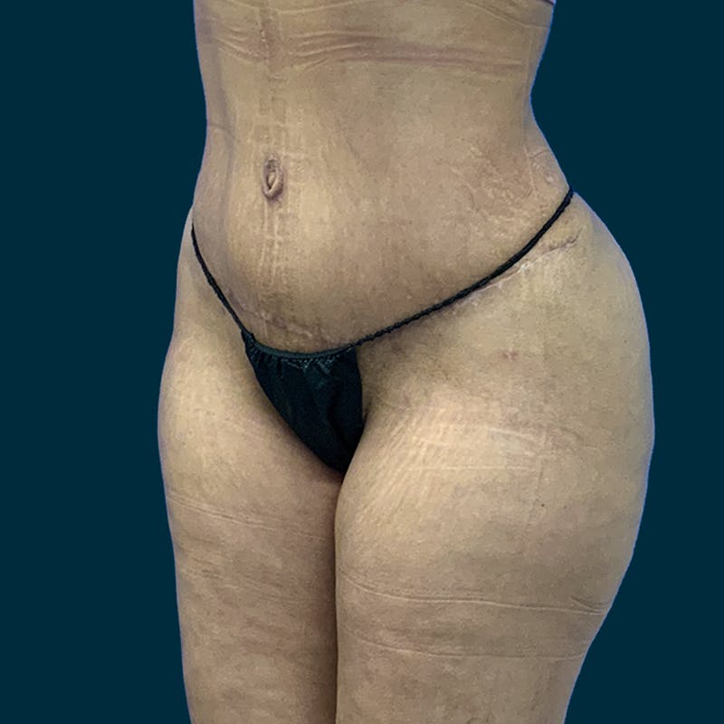 Liposuction Before & After Gallery - Patient 226332 - Image 6