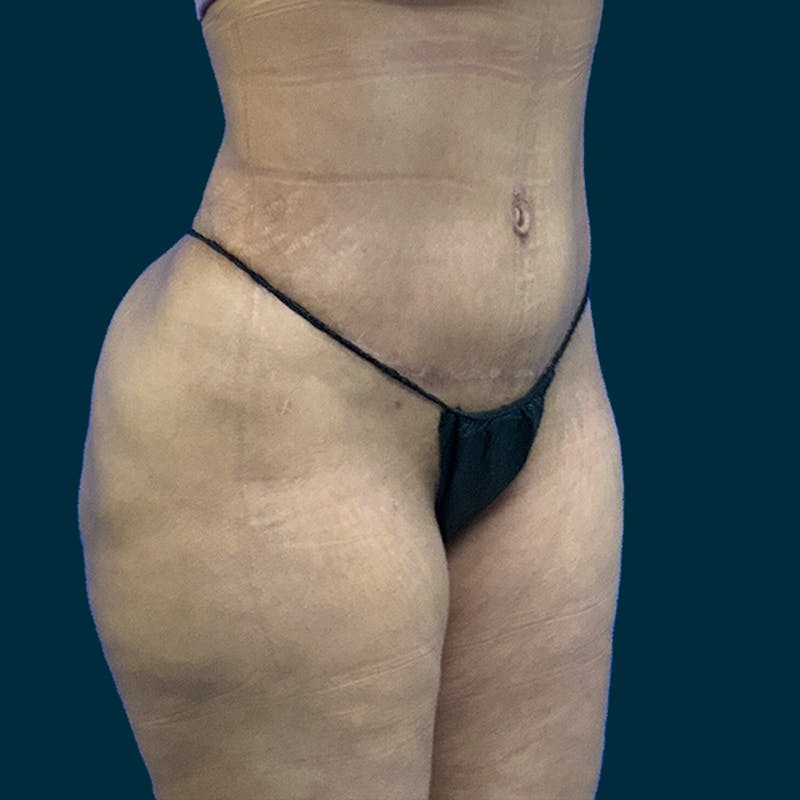 Liposuction Before & After Gallery - Patient 226332 - Image 2