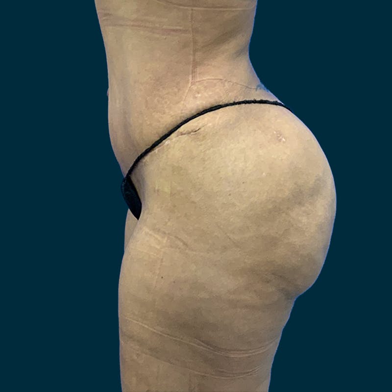 Liposuction Before & After Gallery - Patient 226332 - Image 8