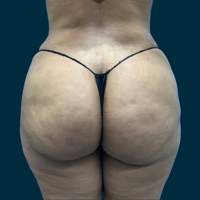 Liposuction Before & After Gallery - Patient 226332 - Image 4