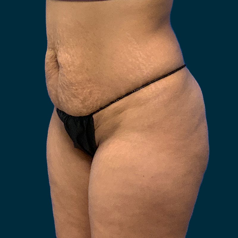 Fat Transfer Before & After Gallery - Patient 601010 - Image 5