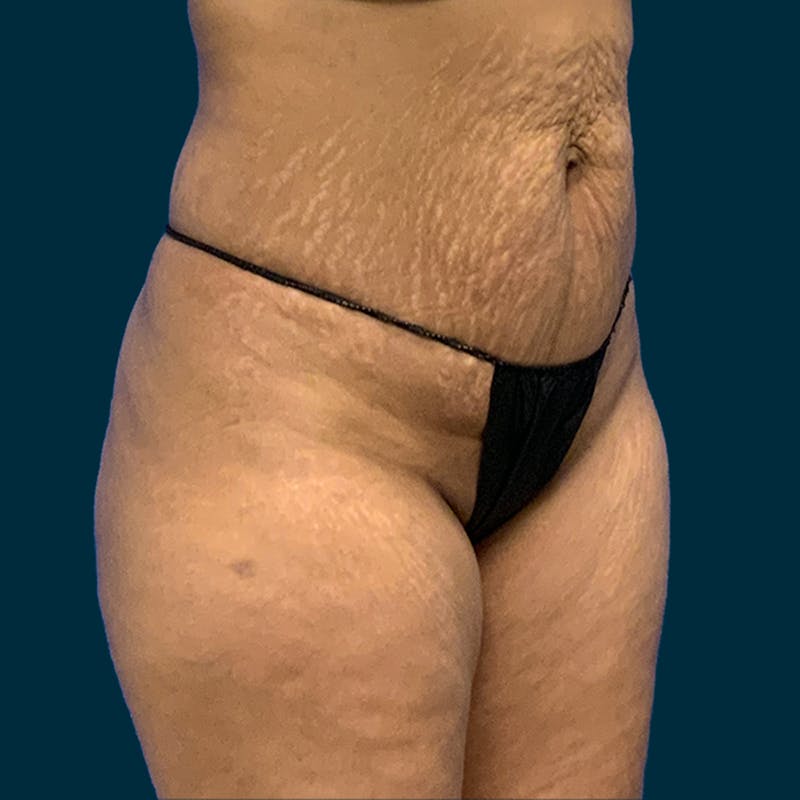 Abdominoplasty Before & After Gallery - Patient 211540 - Image 3