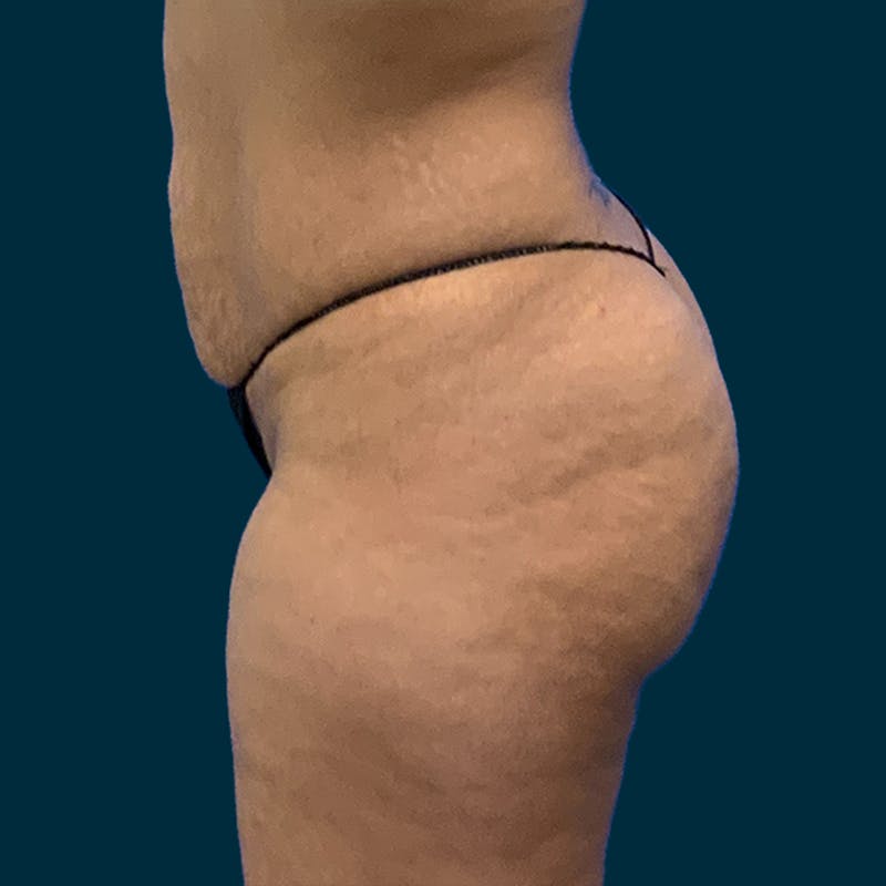 Liposuction Before & After Gallery - Patient 226332 - Image 7