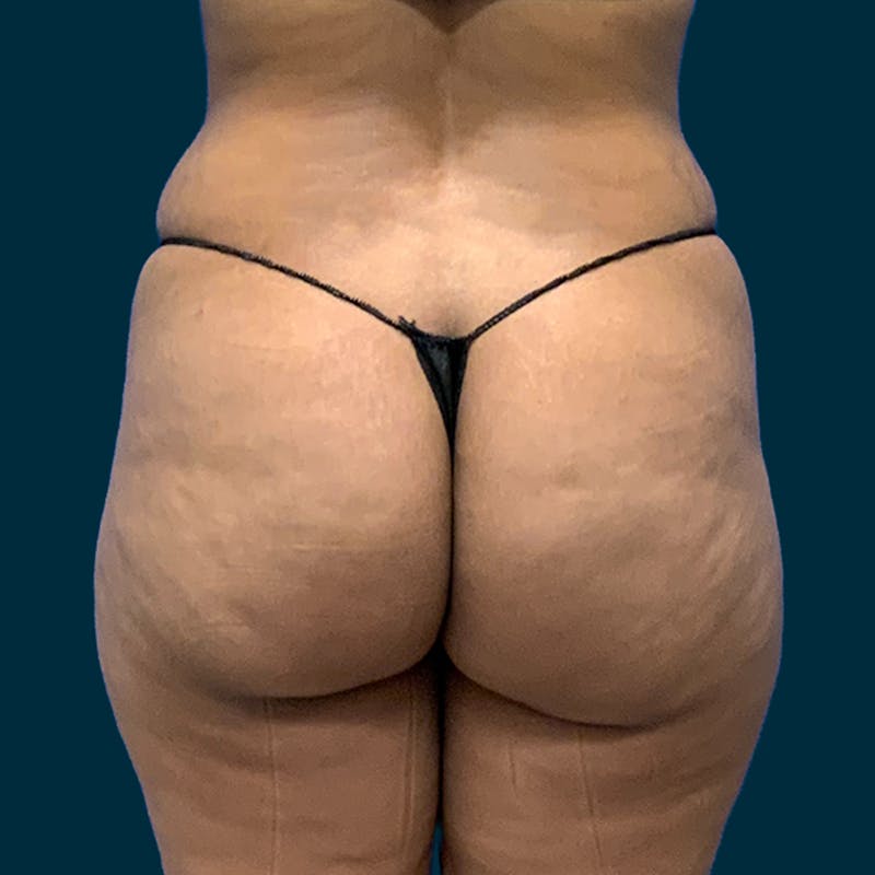 Liposuction Before & After Gallery - Patient 226332 - Image 3
