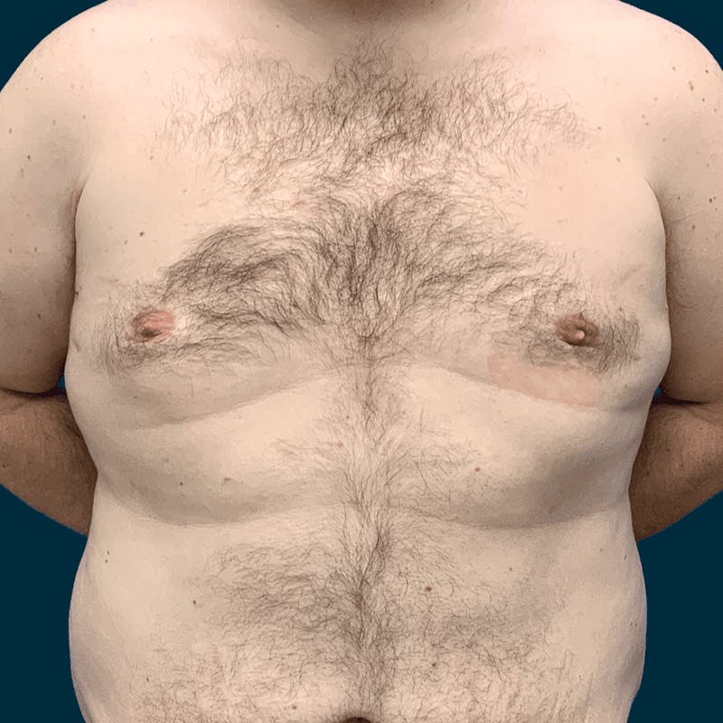 Gynecomastia Before & After Gallery - Patient 372649 - Image 2