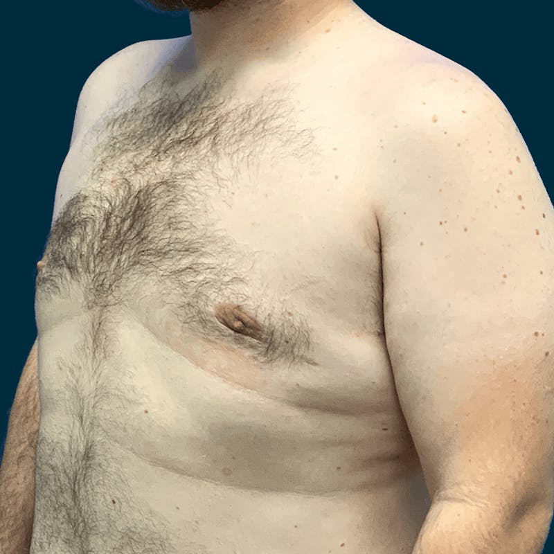 Gynecomastia Before & After Gallery - Patient 372649 - Image 4