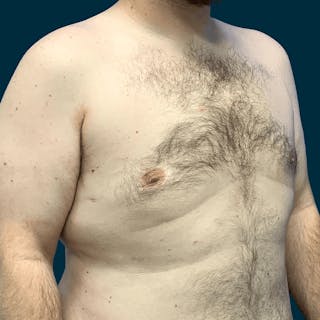 Gynecomastia Before & After Gallery - Patient 372649 - Image 6