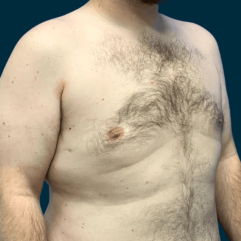 Gynecomastia Before & After Gallery - Patient 372649 - Image 6