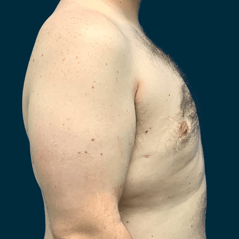Gynecomastia Before & After Gallery - Patient 372649 - Image 8