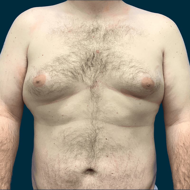 Gynecomastia Before & After Gallery - Patient 372649 - Image 1