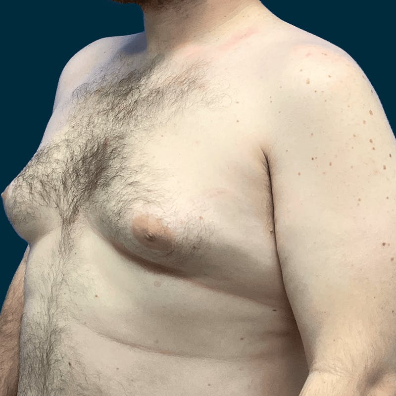 Gynecomastia Before & After Gallery - Patient 372649 - Image 3