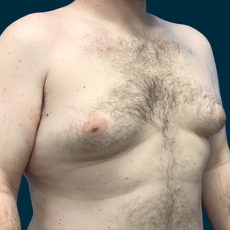 Gynecomastia Before & After Gallery - Patient 372649 - Image 5