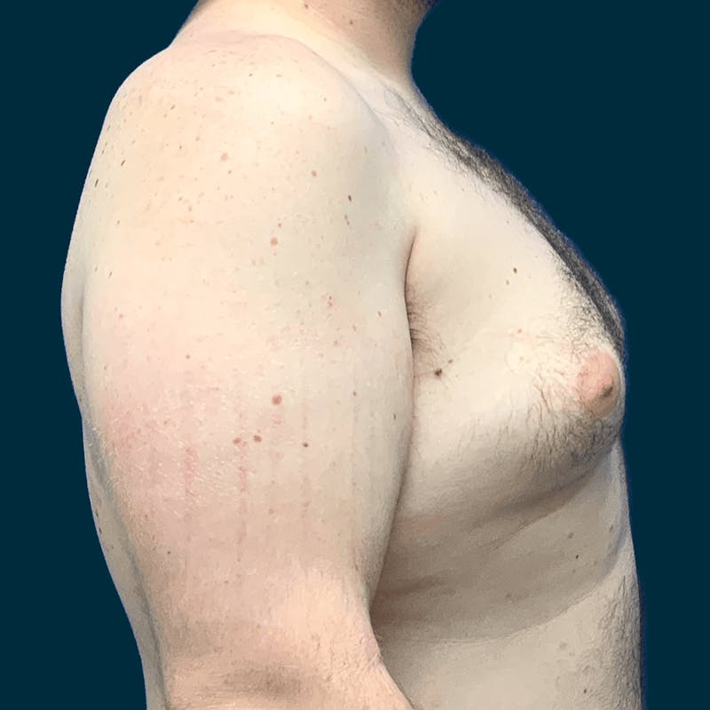 Gynecomastia Before & After Gallery - Patient 372649 - Image 7